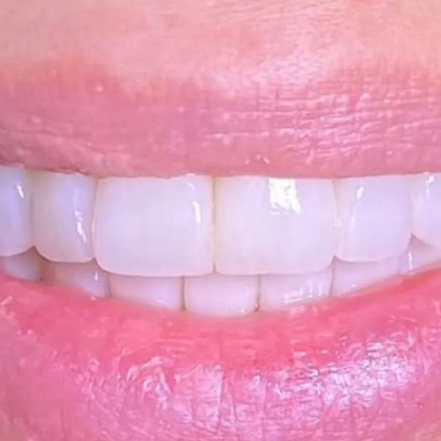 Dopo - Trasformazione del sorriso
